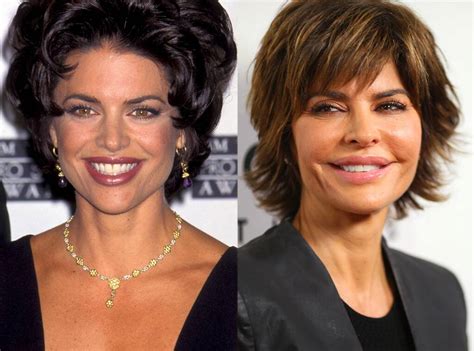 lisa rinna before lip injections